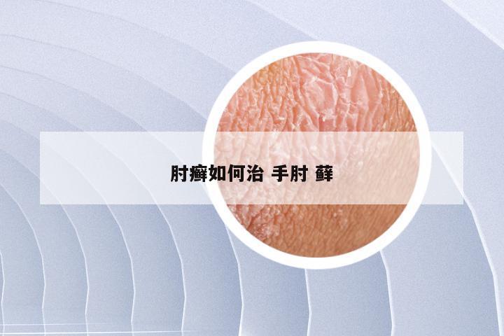 肘癣如何治 手肘 藓