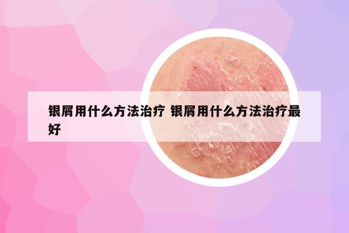 银屑用什么方法治疗 银屑用什么方法治疗最好
