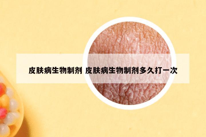 皮肤病生物制剂 皮肤病生物制剂多久打一次