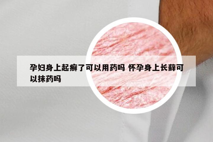 孕妇身上起癣了可以用药吗 怀孕身上长藓可以抹药吗