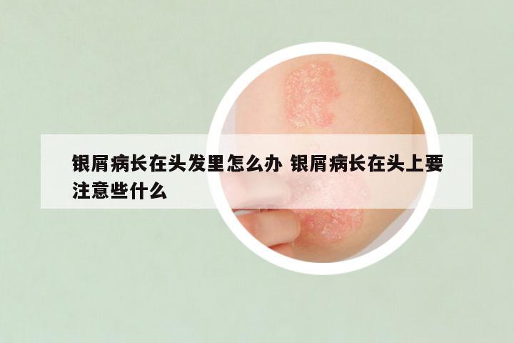 银屑病长在头发里怎么办 银屑病长在头上要注意些什么
