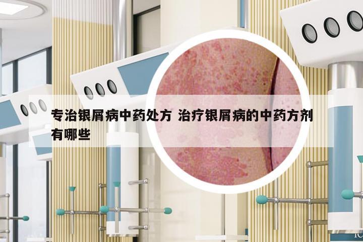 专治银屑病中药处方 治疗银屑病的中药方剂有哪些