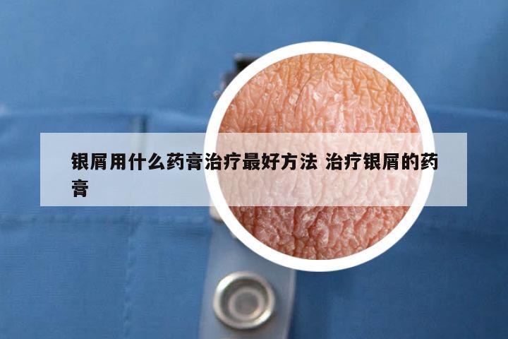 银屑用什么药膏治疗最好方法 治疗银屑的药膏