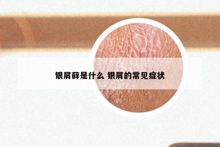 银屑藓是什么 银屑的常见症状
