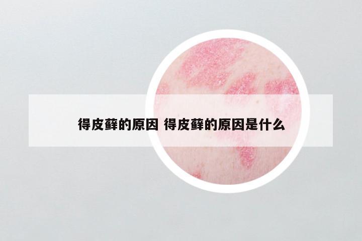 得皮藓的原因 得皮藓的原因是什么
