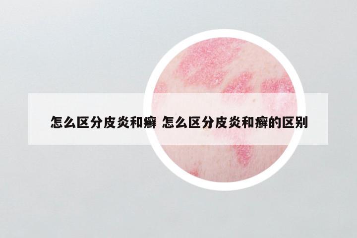 怎么区分皮炎和癣 怎么区分皮炎和癣的区别