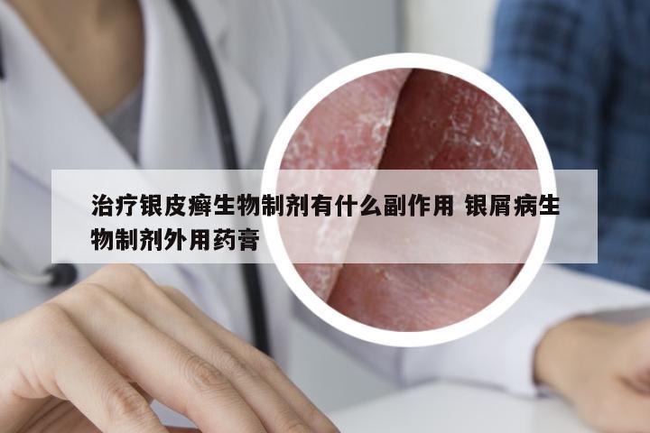 治疗银皮癣生物制剂有什么副作用 银屑病生物制剂外用药膏