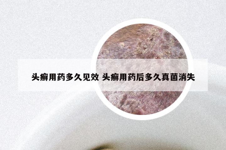 头癣用药多久见效 头癣用药后多久真菌消失
