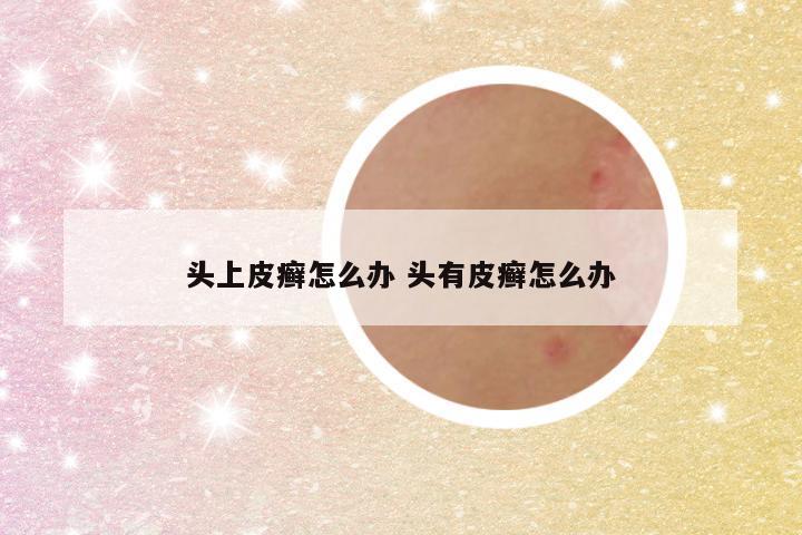头上皮癣怎么办 头有皮癣怎么办