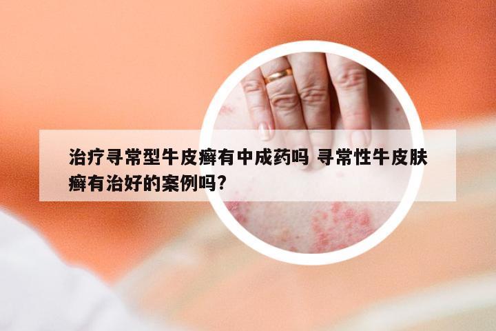 治疗寻常型牛皮癣有中成药吗 寻常性牛皮肤癣有治好的案例吗?