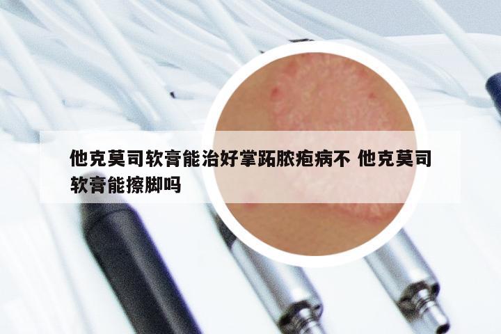 他克莫司软膏能治好掌跖脓疱病不 他克莫司软膏能擦脚吗