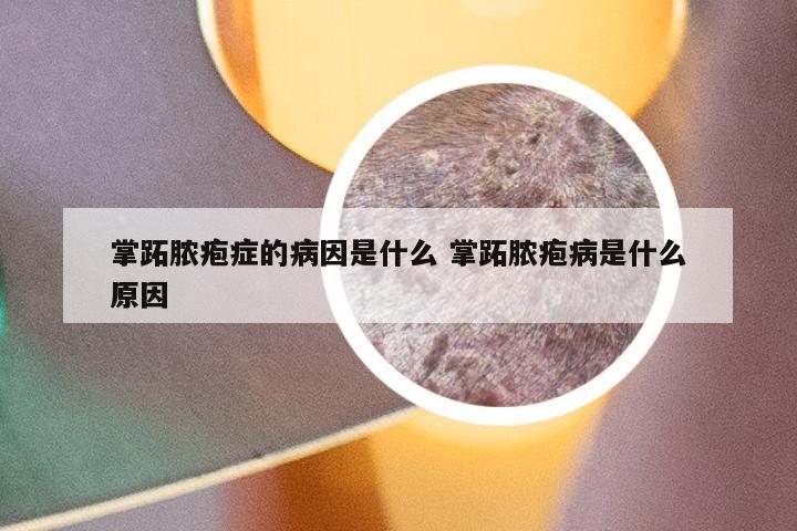 掌跖脓疱症的病因是什么 掌跖脓疱病是什么原因