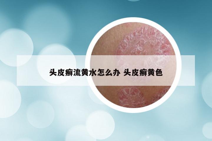 头皮癣流黄水怎么办 头皮癣黄色
