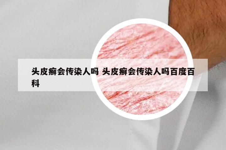头皮癣会传染人吗 头皮癣会传染人吗百度百科