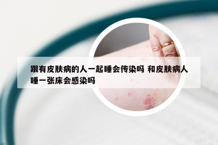 跟有皮肤病的人一起睡会传染吗 和皮肤病人睡一张床会感染吗