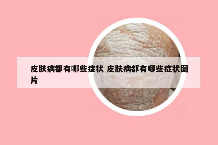 皮肤病都有哪些症状 皮肤病都有哪些症状图片