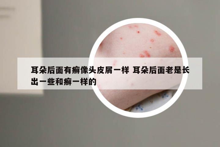耳朵后面有癣像头皮屑一样 耳朵后面老是长出一些和癣一样的