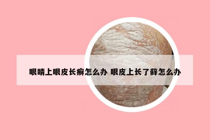 眼睛上眼皮长癣怎么办 眼皮上长了藓怎么办