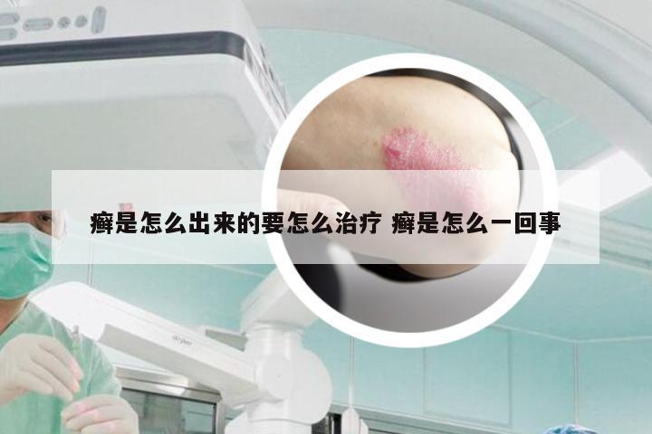 癣是怎么出来的要怎么治疗 癣是怎么一回事