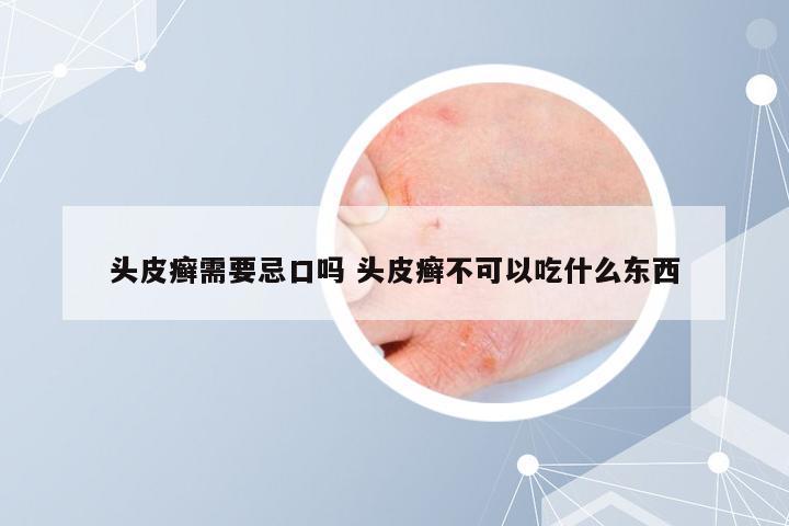 头皮癣需要忌口吗 头皮癣不可以吃什么东西