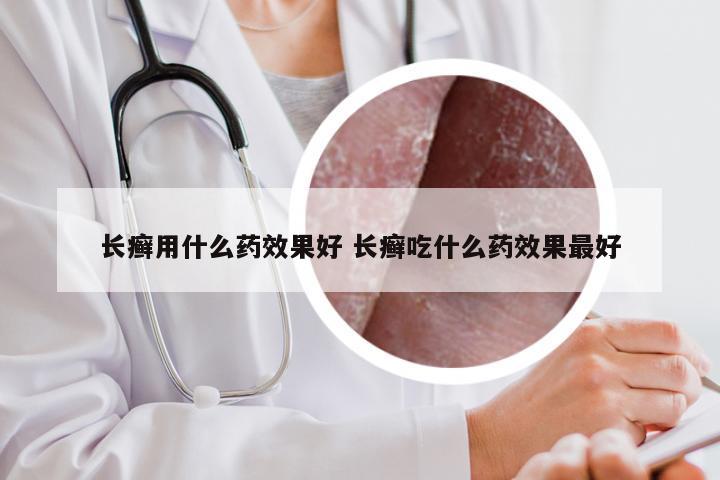 长癣用什么药效果好 长癣吃什么药效果最好