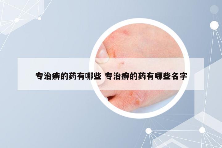 专治癣的药有哪些 专治癣的药有哪些名字