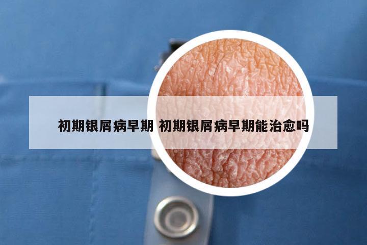 初期银屑病早期 初期银屑病早期能治愈吗