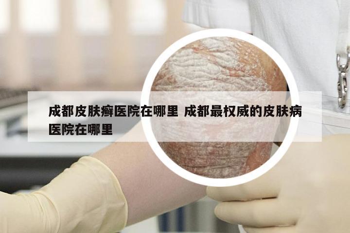 成都皮肤癣医院在哪里 成都最权威的皮肤病医院在哪里