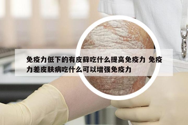 免疫力低下的有皮藓吃什么提高免疫力 免疫力差皮肤病吃什么可以增强免疫力