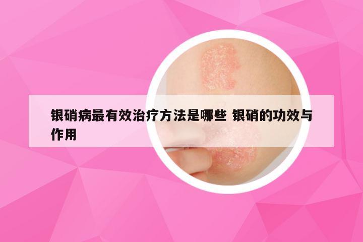 银硝病最有效治疗方法是哪些 银硝的功效与作用