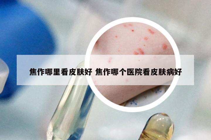 焦作哪里看皮肤好 焦作哪个医院看皮肤病好