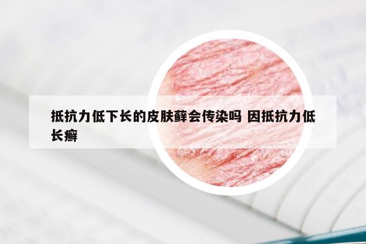 抵抗力低下长的皮肤藓会传染吗 因抵抗力低长癣