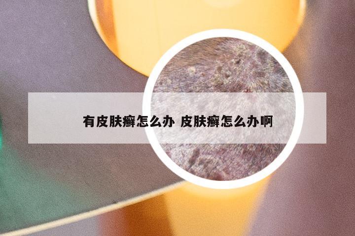 有皮肤癣怎么办 皮肤癣怎么办啊