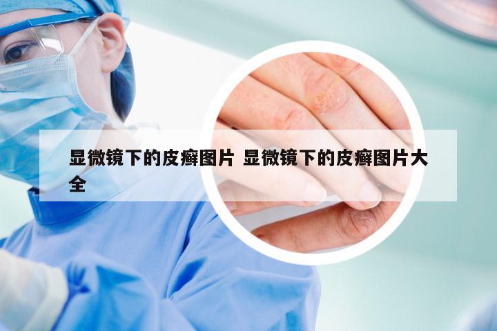 显微镜下的皮癣图片 显微镜下的皮癣图片大全