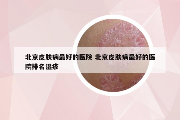 北京皮肤病最好的医院 北京皮肤病最好的医院排名湿疹