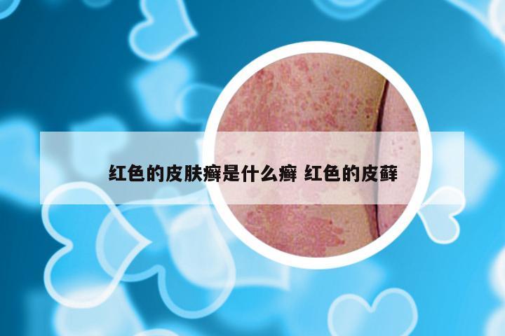 红色的皮肤癣是什么癣 红色的皮藓
