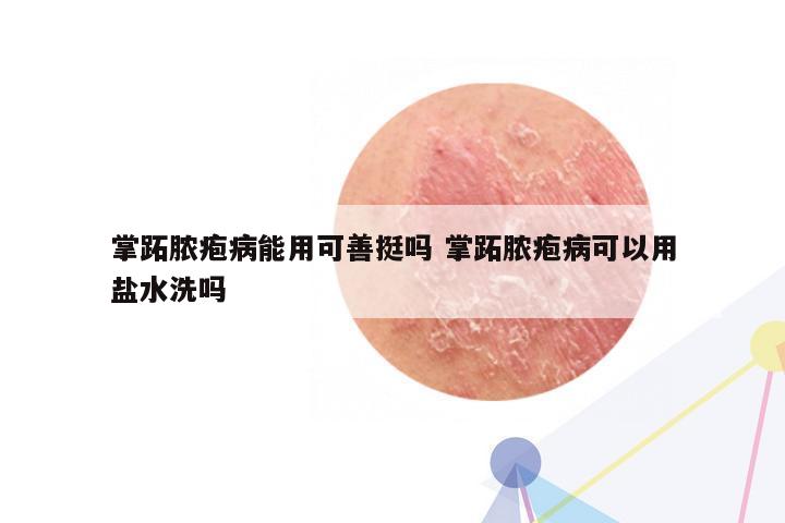 掌跖脓疱病能用可善挺吗 掌跖脓疱病可以用盐水洗吗