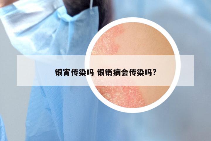 银宵传染吗 银销病会传染吗?