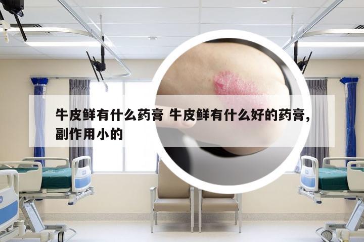 牛皮鲜有什么药膏 牛皮鲜有什么好的药膏,副作用小的