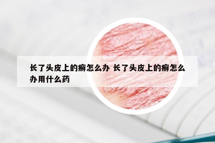 长了头皮上的癣怎么办 长了头皮上的癣怎么办用什么药