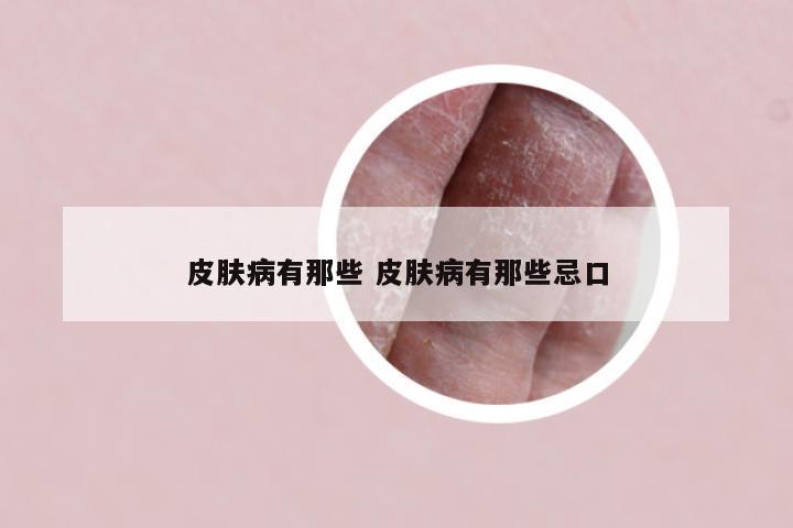 皮肤病有那些 皮肤病有那些忌口