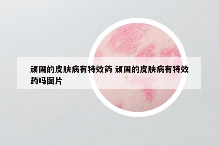 顽固的皮肤病有特效药 顽固的皮肤病有特效药吗图片