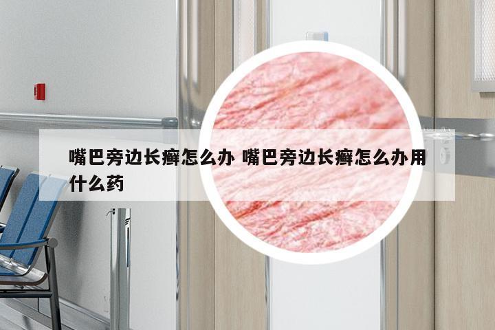 嘴巴旁边长癣怎么办 嘴巴旁边长癣怎么办用什么药