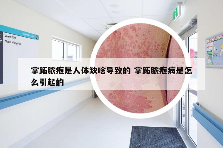 掌跖脓疱是人体缺啥导致的 掌跖脓疱病是怎么引起的