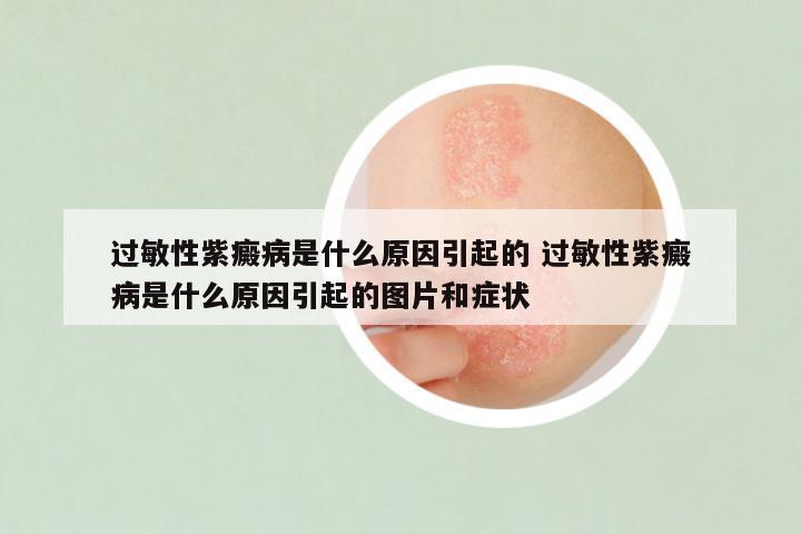 过敏性紫癜病是什么原因引起的 过敏性紫癜病是什么原因引起的图片和症状
