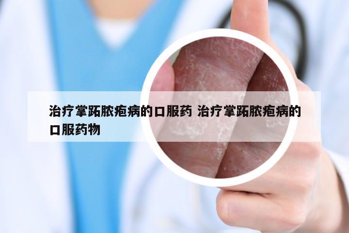 治疗掌跖脓疱病的口服药 治疗掌跖脓疱病的口服药物