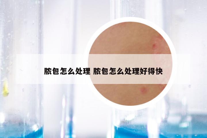 脓包怎么处理 脓包怎么处理好得快