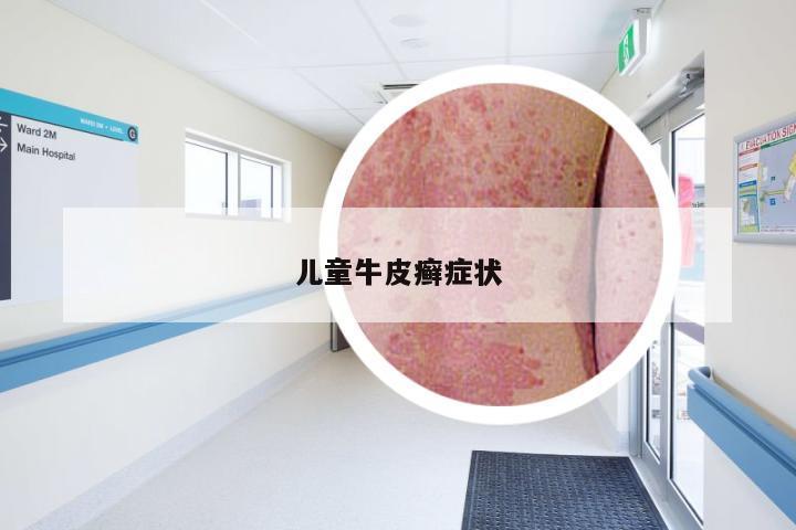 儿童牛皮癣症状
