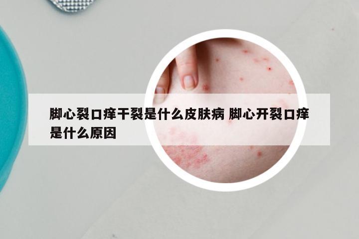 脚心裂口痒干裂是什么皮肤病 脚心开裂口痒是什么原因