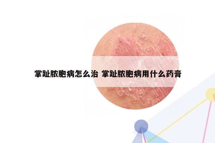掌趾脓胞病怎么治 掌趾脓胞病用什么药膏